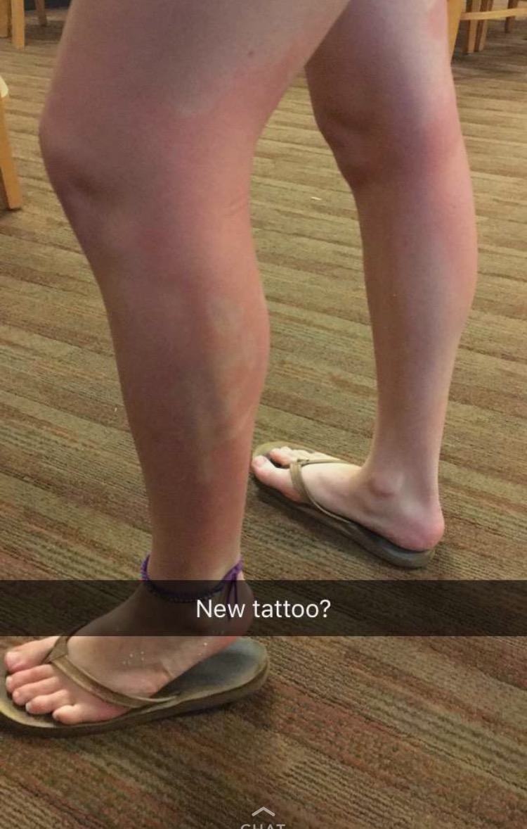 The author's unfortunate and abstract sunburn. (JULIE PLUMMER/The Stanford Daily)