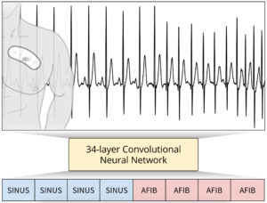 Newly developed algorithm diagnoses cardiac arrhythmias with the accuracy of cardiologists
