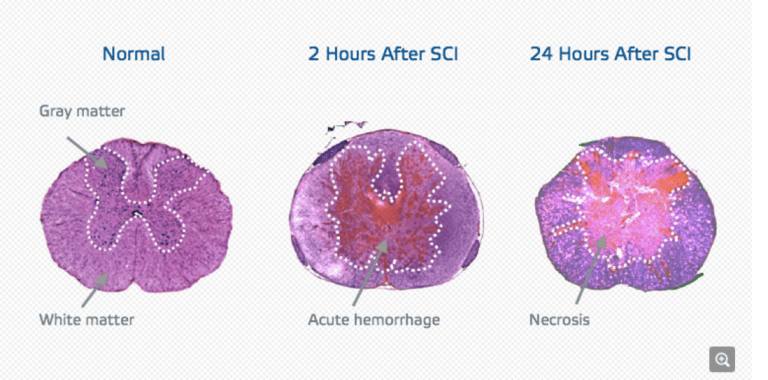 Stanford is the next center for spinal scaffold research (Courtesy of InVivo Therapeutics).